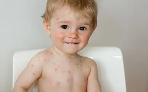 Uśmiechnięty maluch z ospą, który już niedługo wróci do przedszkola.