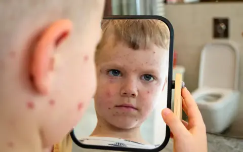 Chłopiec z ospą patrzy w lustro, szukając sposobów, jak uśmierzyć swędzenie przy ospie.