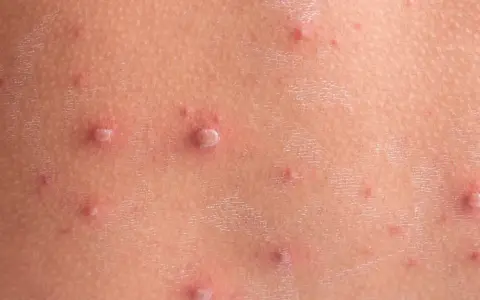 Zmiany skórne po ospie. Jak przyspieszyć gojenie ospy? Widoczne pęcherzyki i zaczerwienienia na skórze.